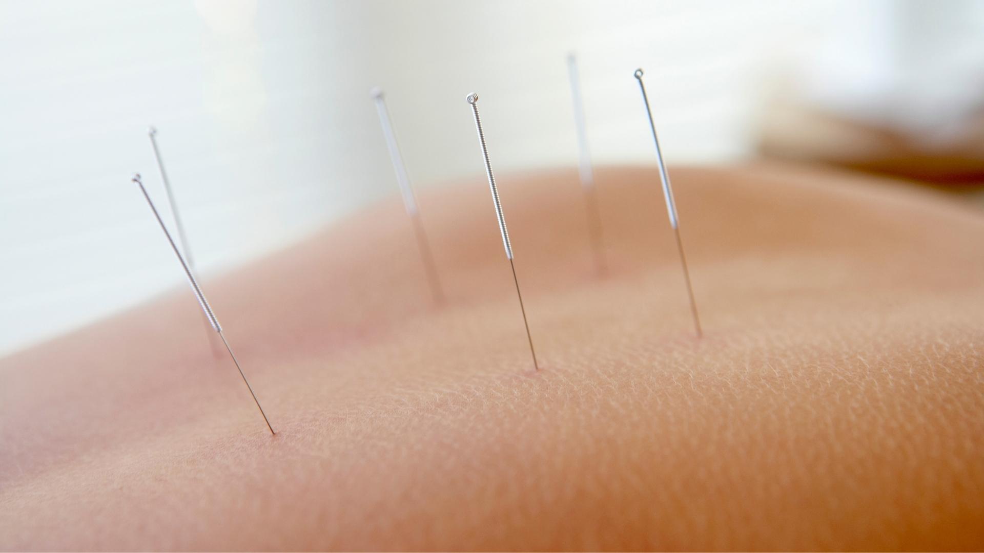 How Does Acupuncture Work Aceso Total Healthcare 